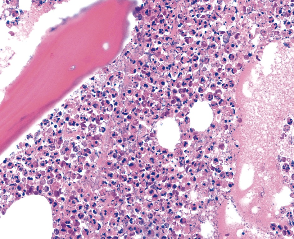 Pathology Outlines Bacterial Osteomyelitis Acute